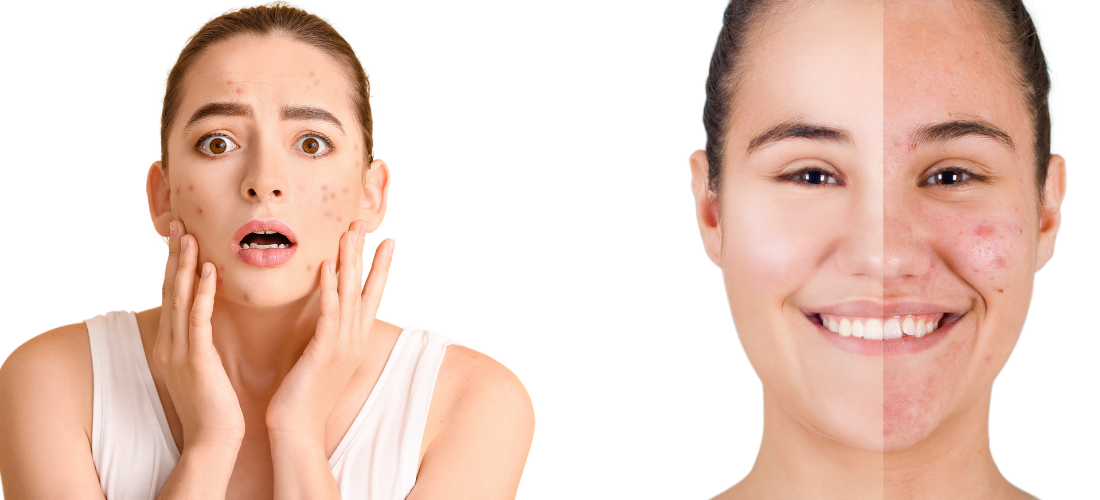 Acne & Acne Scar Treatment